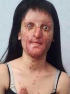 Lady Marries Boyfriend Who Disfigured Her In Horrific Acid Attack (Warning Graphic Images)