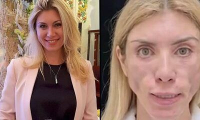 Russian beauty queen claims Plastic Surgery left her ‘disfigured’