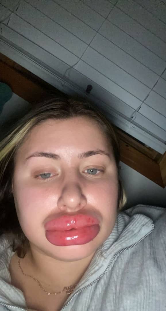 Woman's Lips Swells X8 After Lips Enlargement Injection (Photos)