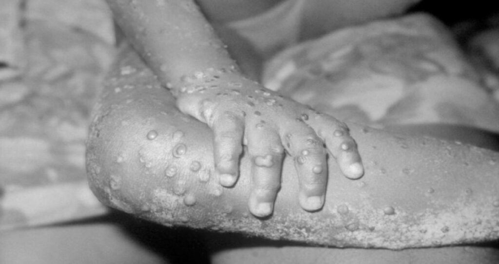 Urgent Call For Volunteer Virologists As Monkey Pox Outbreak Spreads