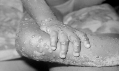 Urgent Call For Volunteer Virologists As Monkey Pox Outbreak Spreads