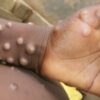 Two More Monkeypox Cases Identified In England