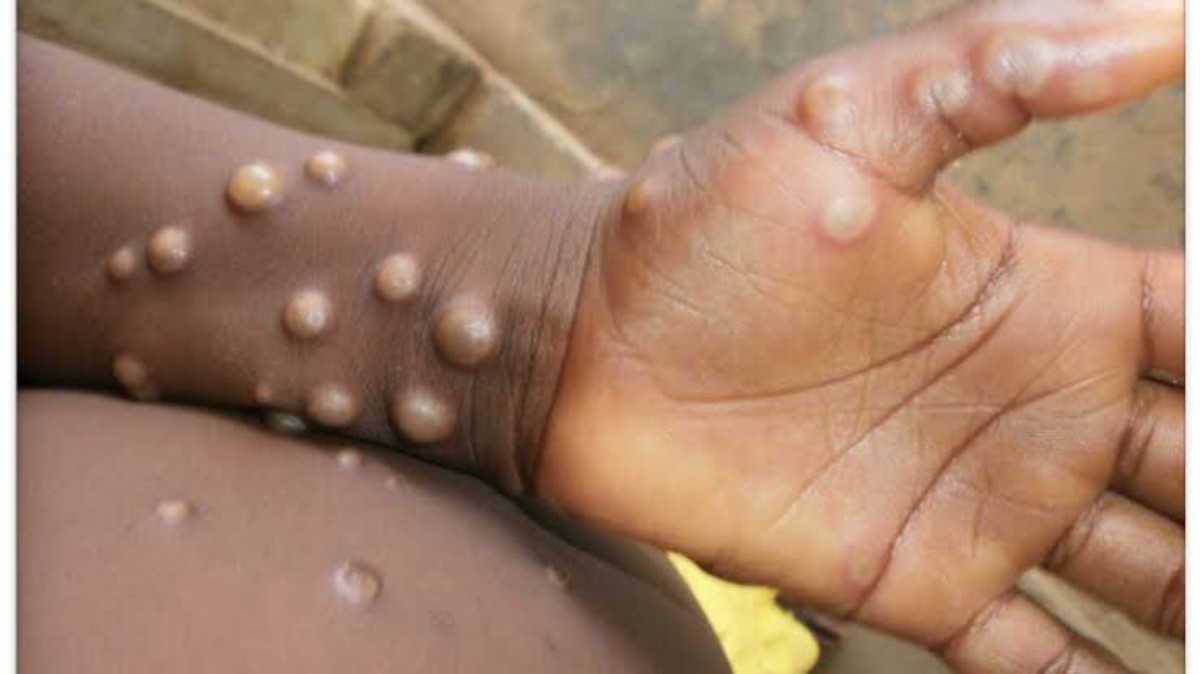 Two More Monkeypox Cases Identified In England