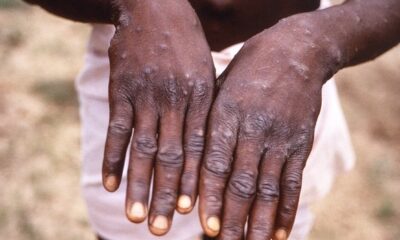 Monkeypox Cases Rise To 157 In Nigeria